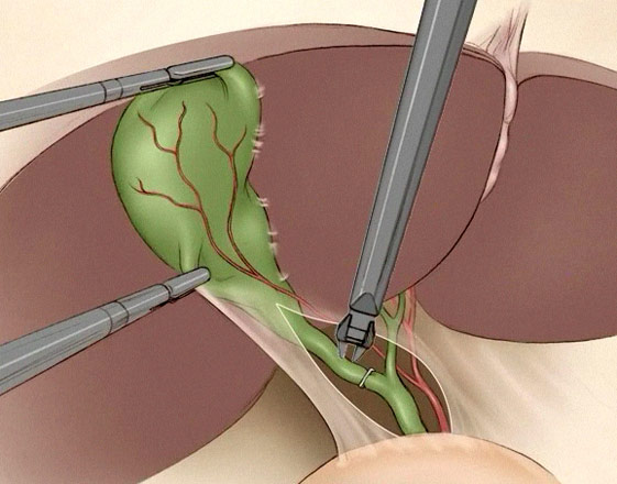 gall bladder surgery